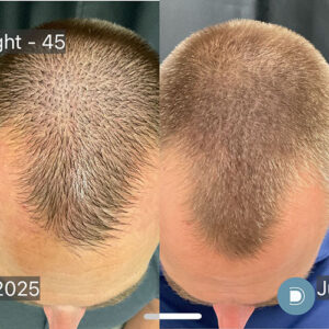 DermaV Ultra Keralase laser hair restoration before and after photo