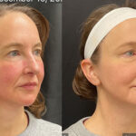 rf microneedling ultra glo derma-v asheville nc