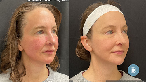 3_dermav-rf-microneedling-ultra-glo.jpg