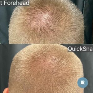 DermaV Ultra Keralase laser hair restoration ba (1)
