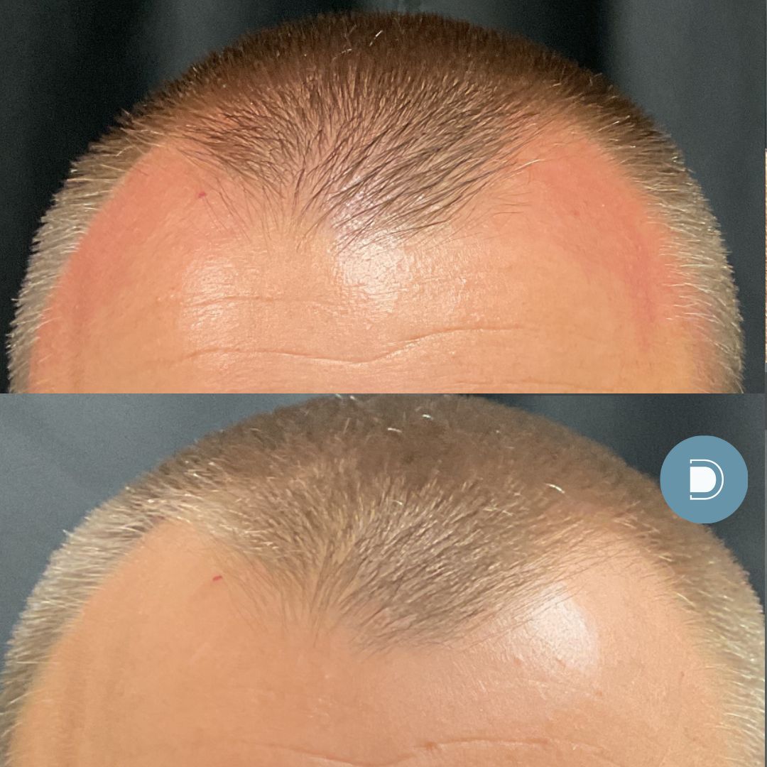 DermaV Ultra Keralase laser hair restoration ba (2)