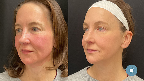 DermaV, rf microneedling, DermaV, and Ultra Glo