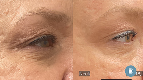 Before and after Ultra Laser Eye Orbital Shield Laser Eye lift