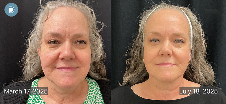 Laser Resurfacing - Lutronic Ultra