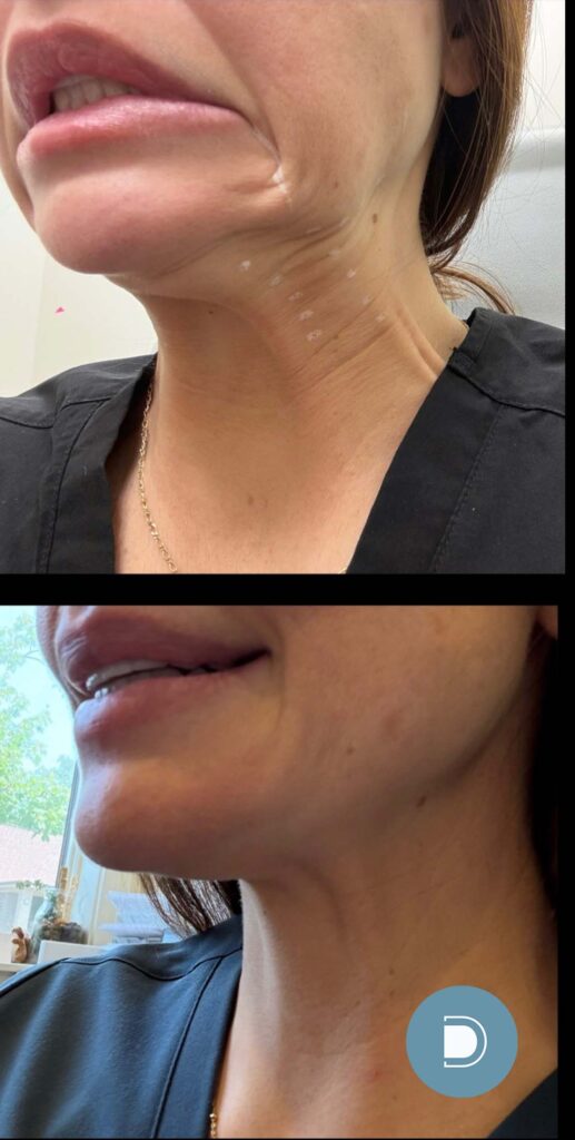 nefertiti-lift-neck-botox-before and after