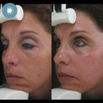 Chemical Peel