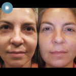 Chemical Peel