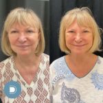 Chemical Peel
