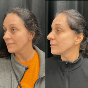DermaV - Joy Lines