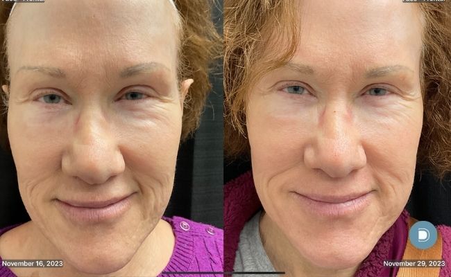 CO-2 Laser Resurfacing Before after