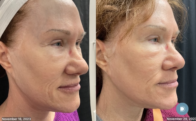 Laser resurfacing results