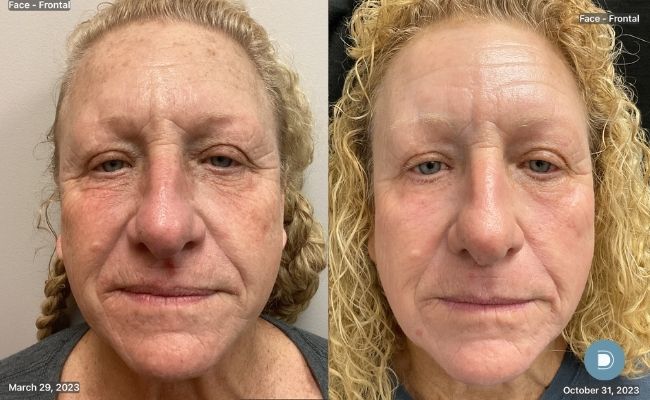 CO2 laser resurfacing before and after DermaBlue