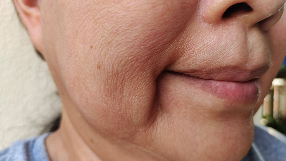 XERF RF Therapy - Non-Surgical Skin Tightening