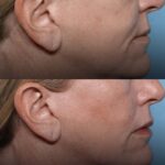 Xerf, before and after on face