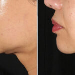 xerf results on face