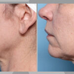 xerf before-afters on face and neck