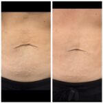 XERF before and after treatment on stomach