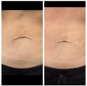 XERF before and after treatment on stomach