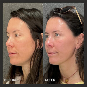 1XerfTreatment_BeforeAfter
