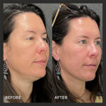 1XerfTreatment_BeforeAfter2