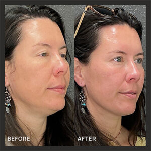 1XerfTreatment_BeforeAfter2