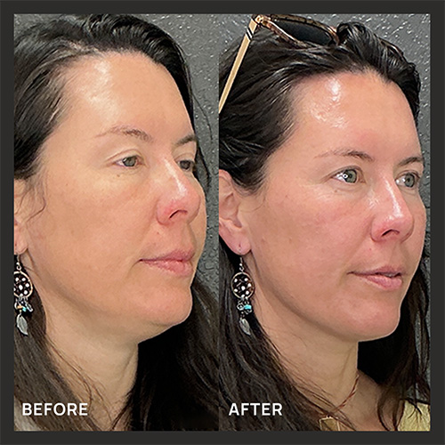 1XerfTreatment_BeforeAfter2
