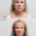 FaceLift and Upper Lid Bleph