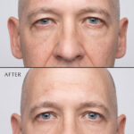 Lower Blepharoplasty Results