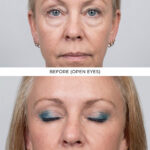 Lower Bleph Results Dr. Levine MD FAAD