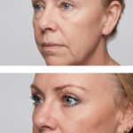 Lower Blepharoplasty Results