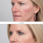 Upper Bleph After Surgery Results Dr. Levine MD FAAD DermaBlue Asheville