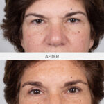 Upper Bleph Before and After Surgery