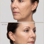 Upper Blepharoplasty Results