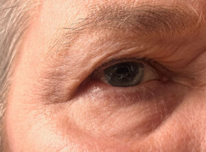 Is Eyelid Surgery Right for You? A Guide to Blepharoplasty