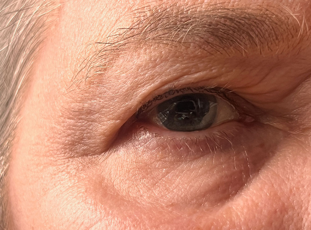 Is Eyelid Surgery Right for You? A Guide to Blepharoplasty