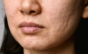 rolling acne scars